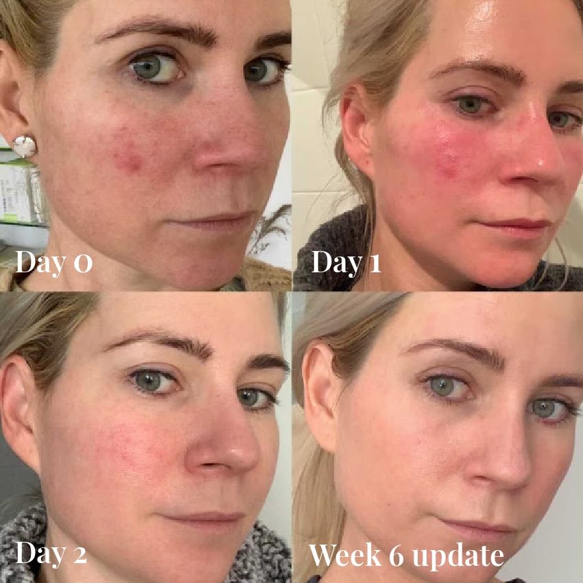 Omnilux LED before and after result 1