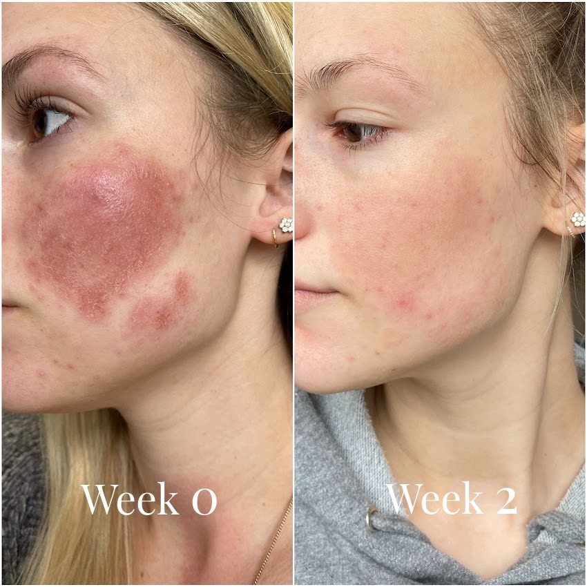 Omnilux LED before and after result 2
