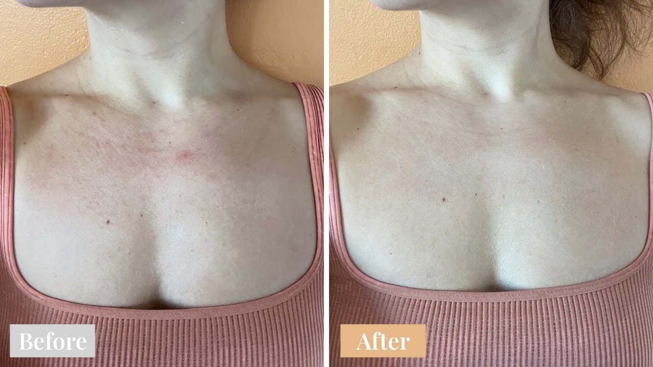 Omnilux LED before and after result 4