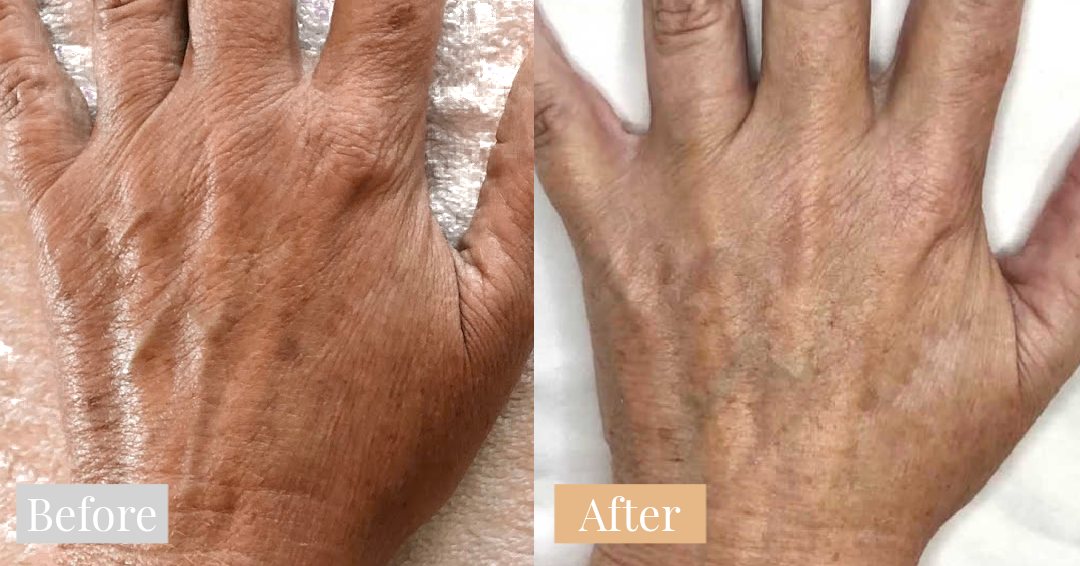 Omnilux LED before and after result 5