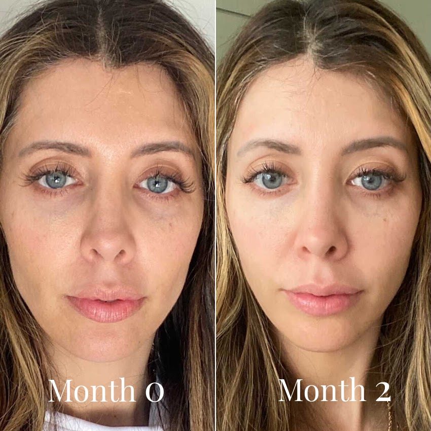 Omnilux LED before and after result 6