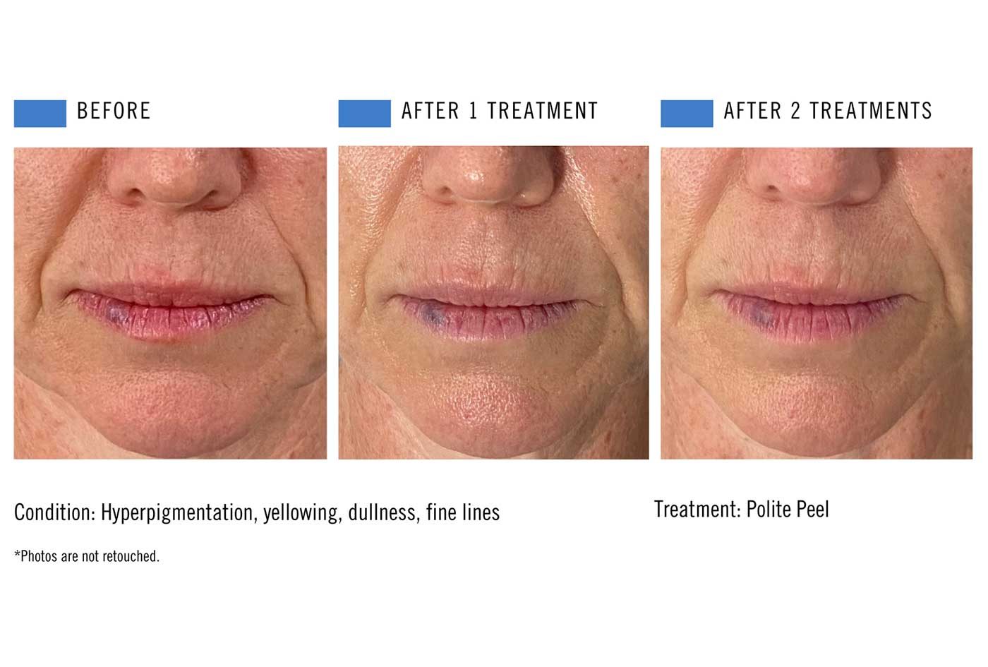 Chemical peel before and after result 1