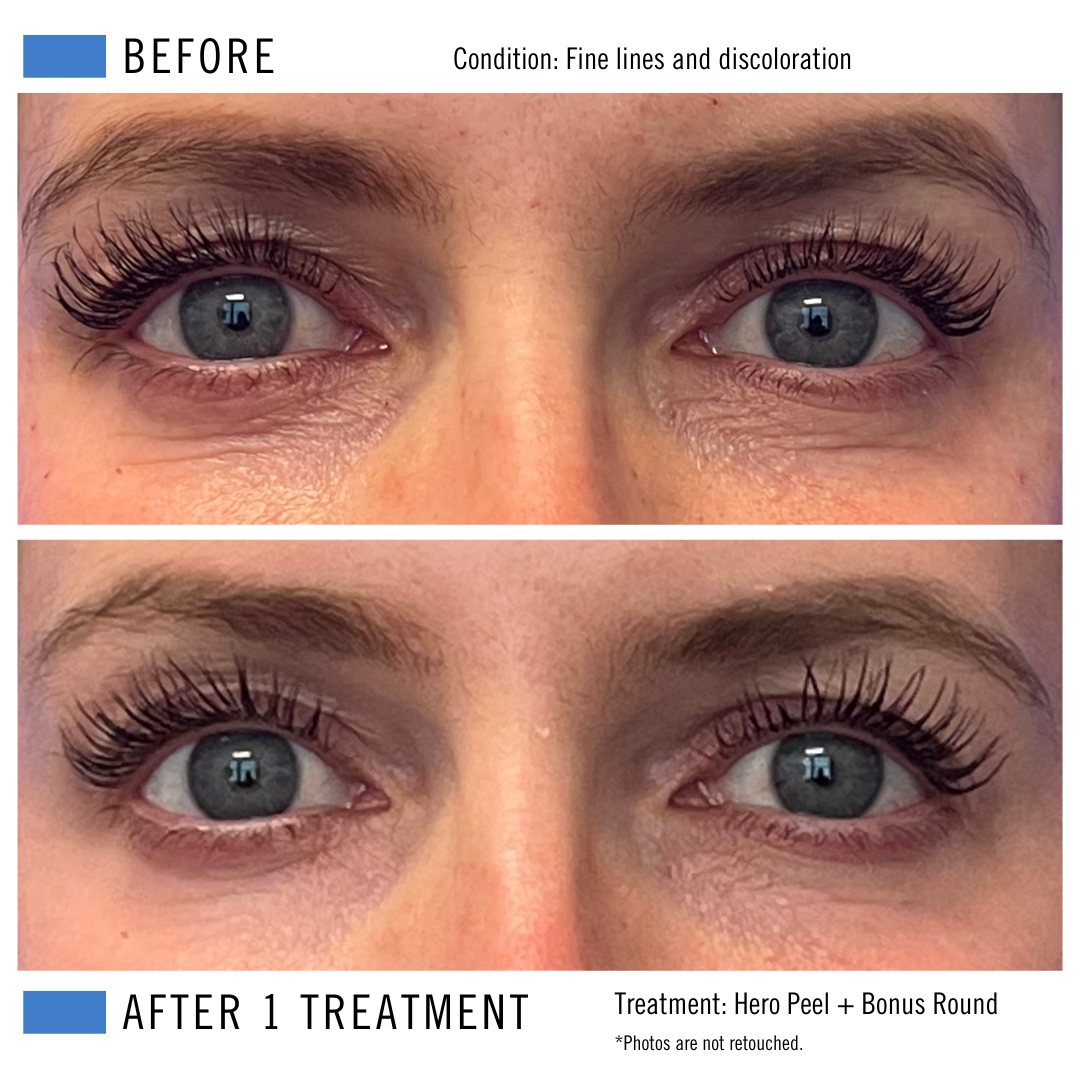 Chemical peel before and after result 2