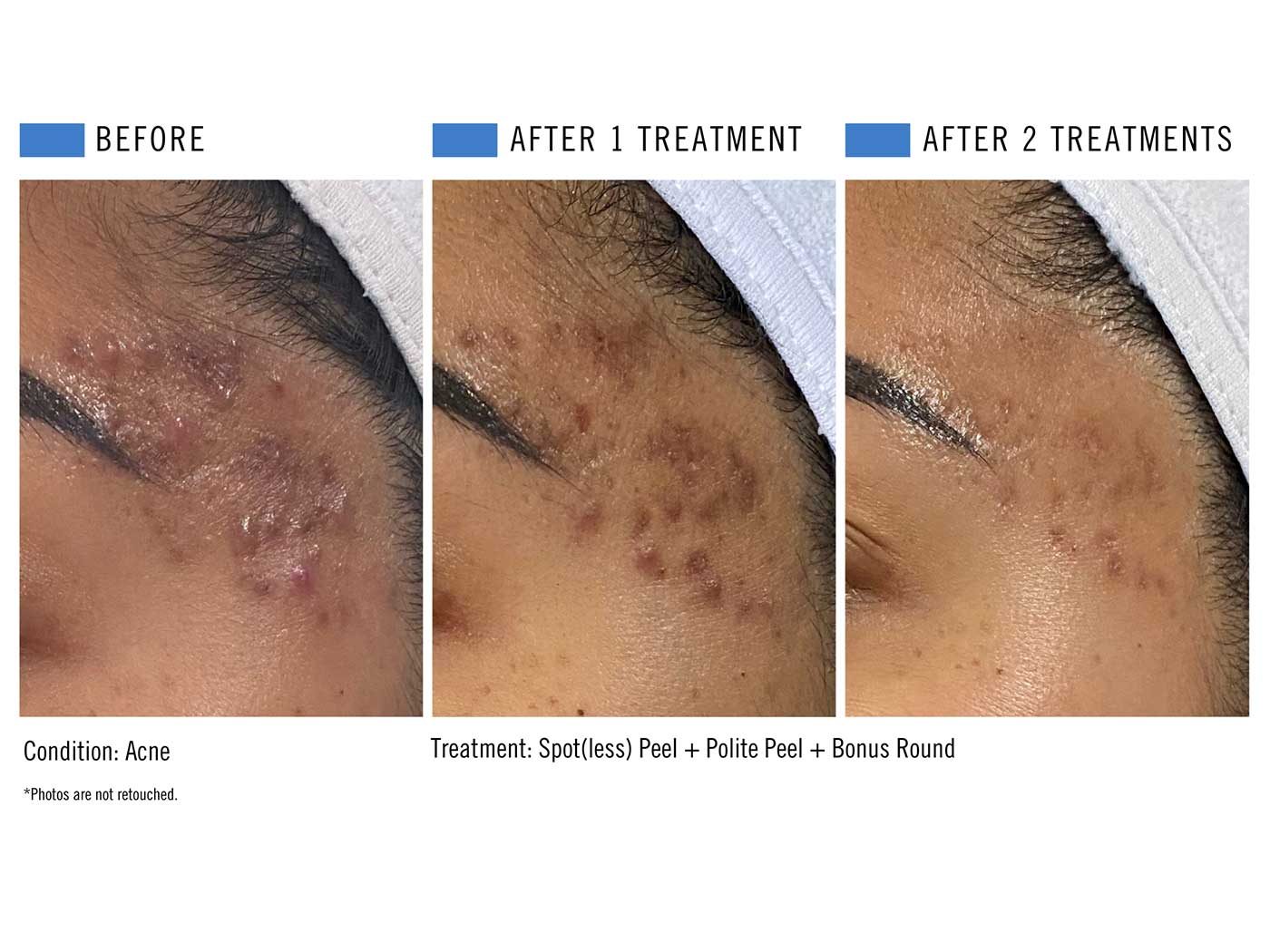 Chemical peel before and after result 3