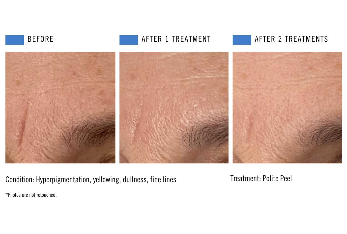Chemical peel before and after result 4