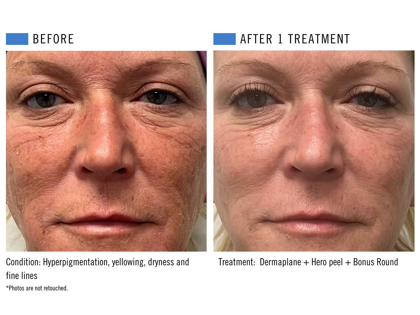 Chemical peel before and after result 5